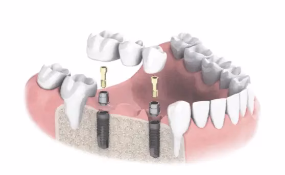 Implantátumokra rögzített fogpótlás illusztráció