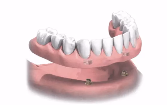 Implantációs kezelés lépései illusztráció