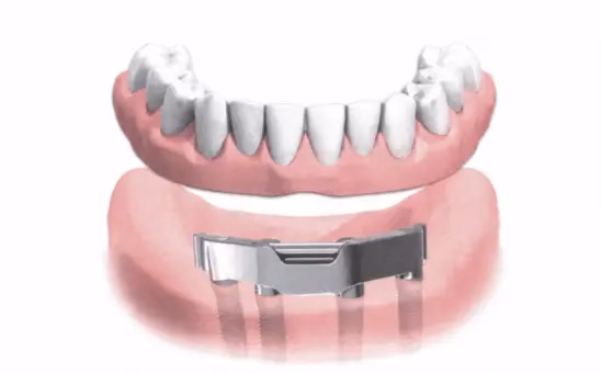 Implantátum és protézis összehasonlítás illusztráció