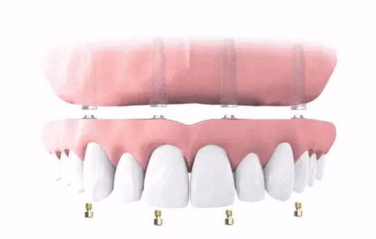 Neoss implantátum illusztráció