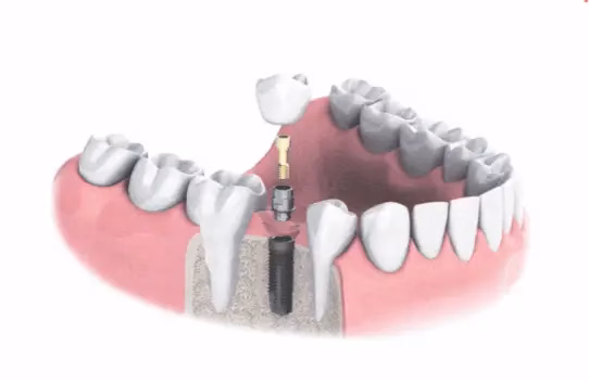 Fogászati implantátum alkalmazási esetek illusztráció