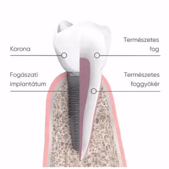 Fogászati implantátum az állcsontban illusztráció